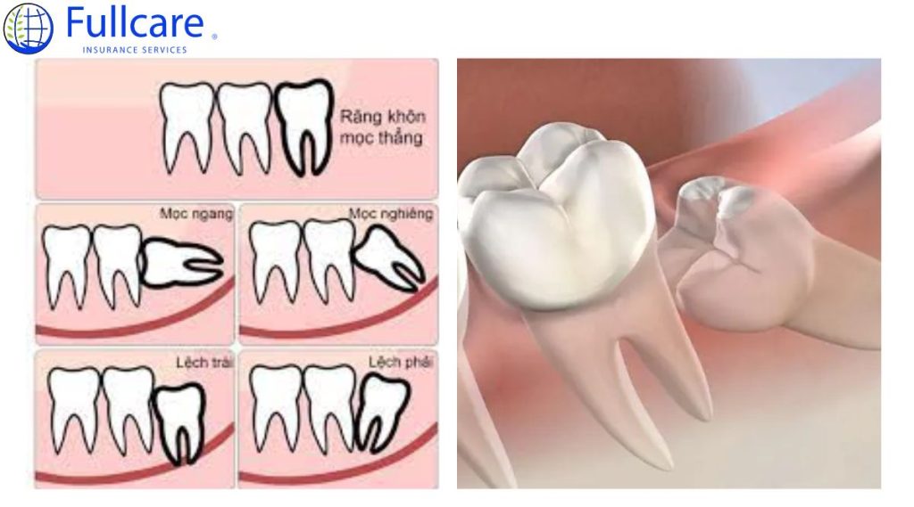 tình trạng răng khôn mọc lệch