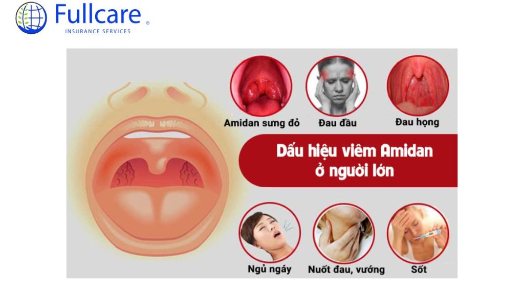 Dấu hiệu viêm amidan ở người lớn