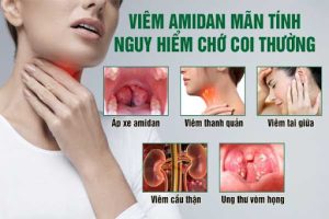 Read more about the article Cắt Amidan: được hưởng các loại bảo hiểm nào? (ví dụ thực tế)